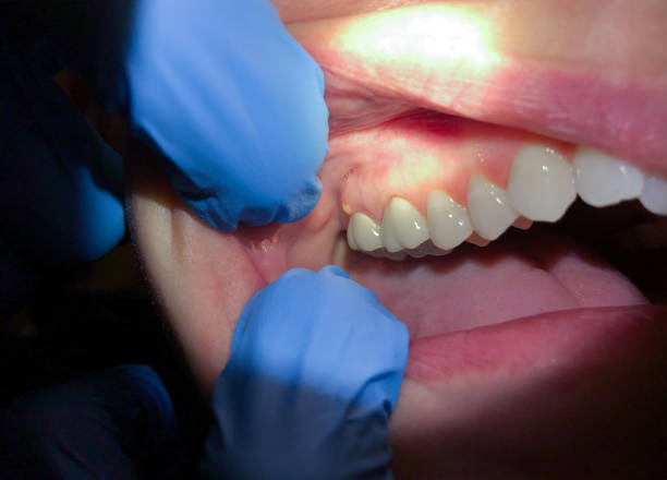Best Emergency Root Canal Treatment in Gothenburg, NE